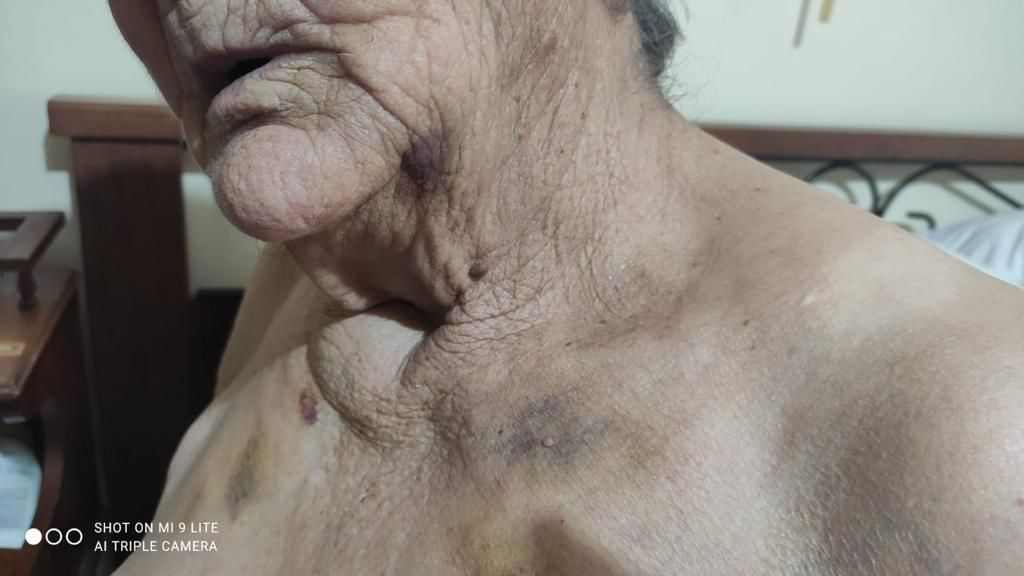 Marigliano, 85enne invalida presa a bastonate dalla badante. Borrelli: "E’ inaccettabile che quella donna lavori ancora presso altre persone anziane. Va fermata” 8 362428617 795422405395478 1590656661617789821 n