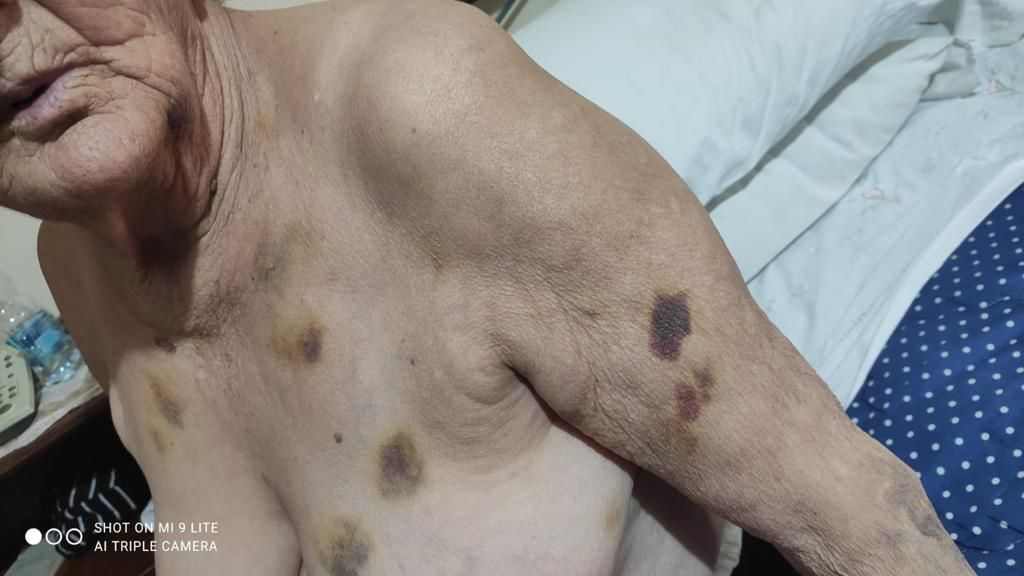 Marigliano, 85enne invalida presa a bastonate dalla badante. Borrelli: "E’ inaccettabile che quella donna lavori ancora presso altre persone anziane. Va fermata” 7 362714705 305180651984073 6043381022355851972 n