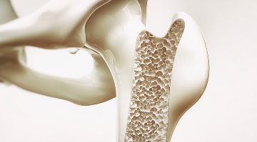 news 28 202002180124 osteoporosi big