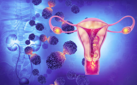 Campania, Tumore dell’utero. Pellegrino (IV): “Giunta regionale in piena sintonia con mia proposta di approccio conservativo nelle patologie benigne” 5 tumore utero e gravidanza