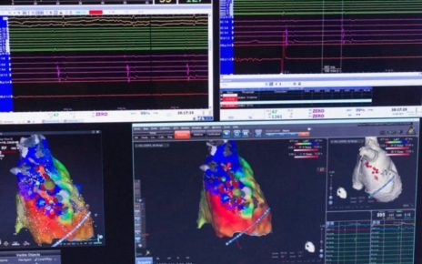 Nola, Sanità: all’Ospedale Santa Maria delle Grazie una Tecnologia Innovativa per le aritmie cardiache più moderna e avanzata in Italia 4 aritmiecardiache1