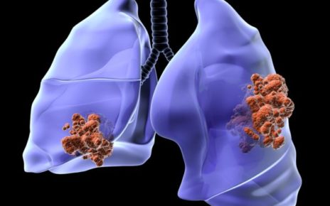 Carcinoma polmonare causa 34mila morti in Italia ogni anno 2 microcitoma