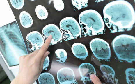 Cardarelli, le nuove terapie per Sclerosi multipla e patologie correlate raccontate dagli stessi pazienti sul canale YouTube 4 msc1q thumb 720 480