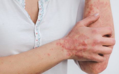 Psoriasi, pressing Apiafco per piano nazionale cronicità 5 qoChe r7l3lc