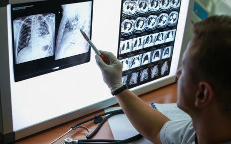 Tumore del polmone: l'immunoterapia cambia la sopravvivenza dei pazienti 6 tumorepolmone thumb 720 480