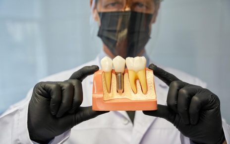 Qual è l’impianto dentale più sicuro? Guida alla scelta migliore 4 perno