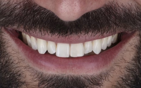 Il sorriso come biglietto da visita: perché sempre più italiani scelgono le faccette dentali all’estero 5 Sorriso